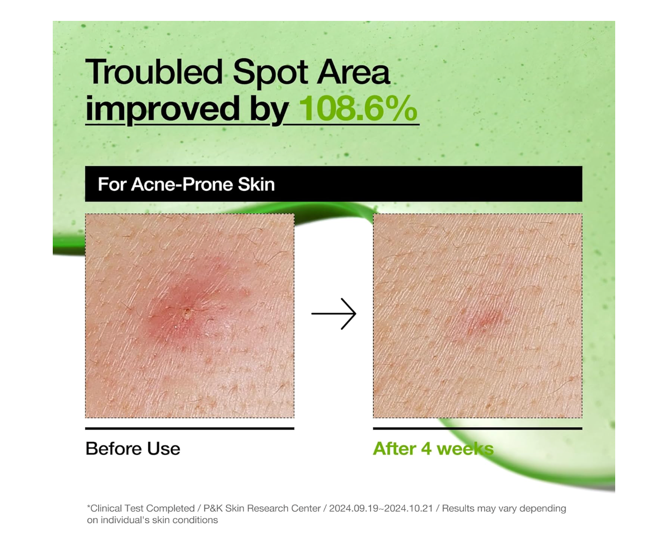 ANUA Azelaic Acid 10 Hyaluron Redness Soothing Serum